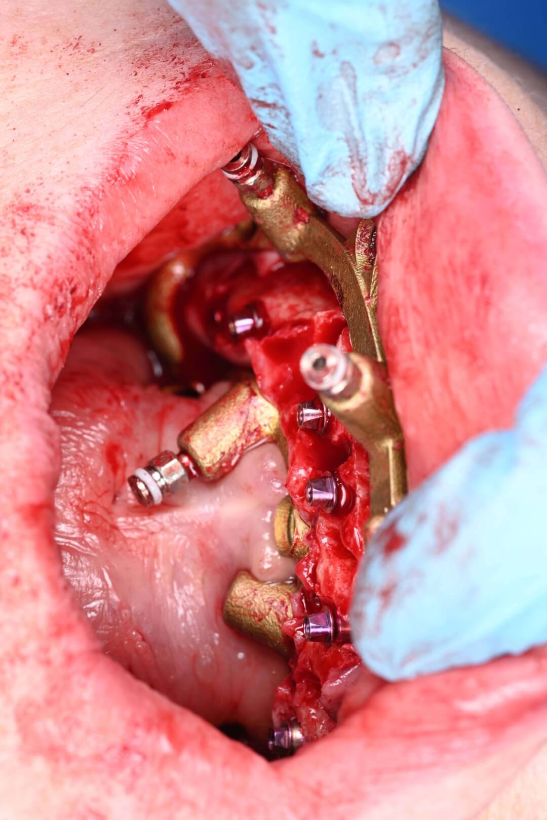 Full Arch Surgery with Dr. Shubhan Mittal